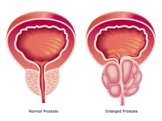 Prostate normale et hypertrophiée